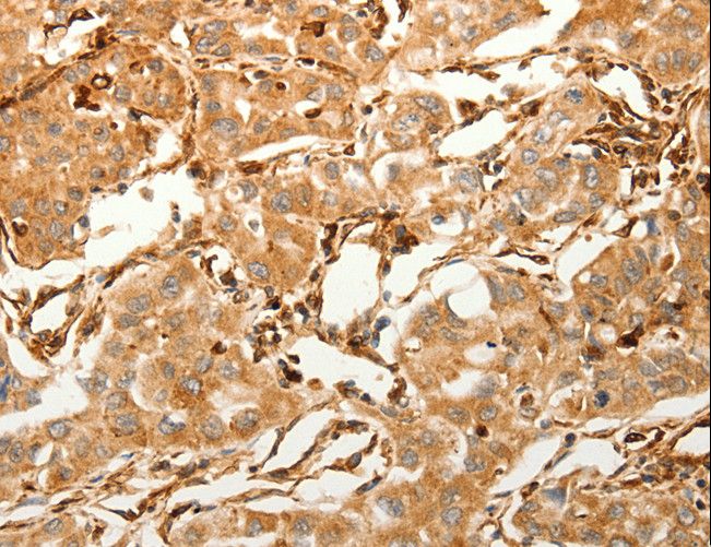 SFRP1 Antibody - Immunohistochemistry of paraffin-embedded Human lung cancer using SFRP1 Polyclonal Antibody at dilution of 1:80.