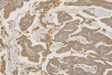 SFRP1 Antibody - IHC staining of FFPE human colon cancer with SFRP1 antibody at 1ug/ml. HIER: boil tissue sections in pH6, 10mM citrate buffer, for 10-20 min and allow to cool before testing.