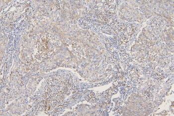 SFRP1 Antibody - IHC staining of FFPE human lung cancer with SFRP1 antibody at 1ug/ml. HIER: boil tissue sections in pH6, 10mM citrate buffer, for 10-20 min and allow to cool before testing.