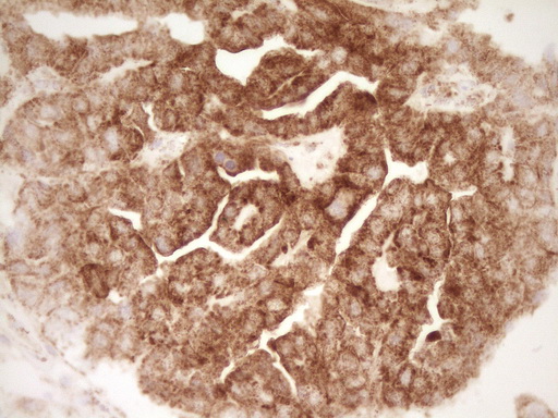 SFRP2 Antibody - Immunohistochemical staining of paraffin-embedded Adenocarcinoma of Human ovary tissue using anti-SFRP2 mouse monoclonal antibody. (Heat-induced epitope retrieval by 1 mM EDTA in 10mM Tris, pH8.5, 120C for 3min,