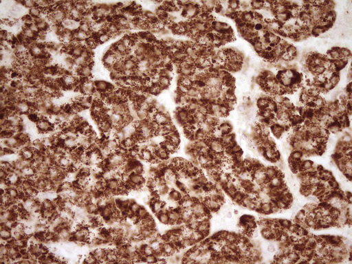 SFRP2 Antibody - Immunohistochemical staining of paraffin-embedded Carcinoma of Human liver tissue using anti-SFRP2 mouse monoclonal antibody. (Heat-induced epitope retrieval by 1 mM EDTA in 10mM Tris, pH8.5, 120C for 3min,