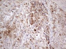 SFRP2 Antibody - Immunohistochemical staining of paraffin-embedded Adenocarcinoma of Human endometrium tissue using anti-SFRP2 mouse monoclonal antibody. (Heat-induced epitope retrieval by 1mM EDTA in 10mM Tris buffer. (pH8.5) at 120°C for 3 min. (1:150)