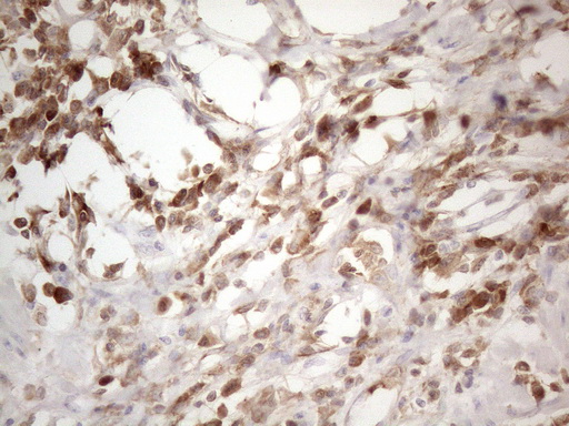 SFRP2 Antibody - Immunohistochemical staining of paraffin-embedded Adenocarcinoma of Human colon tissue using anti-SFRP2 mouse monoclonal antibody. (Heat-induced epitope retrieval by 1mM EDTA in 10mM Tris buffer. (pH8.5) at 120°C for 3 min. (1:150)