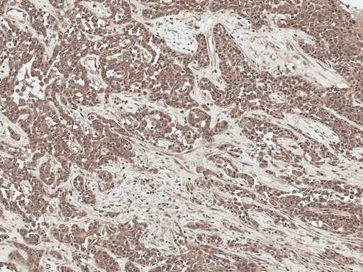 SFRP2 Antibody - Immunohistochemistry analysis using Rabbit Anti-SFRP2 Polyclonal Antibody. Tissue: Liver. Species: Human. Fixation: Formalin Fixed Paraffin-Embedded. Primary Antibody: Rabbit Anti-SFRP2 Polyclonal Antibody  at 1:50 for 30 min at RT. Counterstain: Hematoxylin. Magnification: 20X. HRP-DAB Detection.