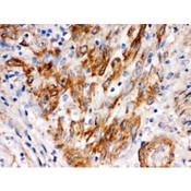 SFRP4 Antibody - SFRP4 was detected in paraffin-embedded sections of human endometrial carcinoma tissues using rabbit anti SFRP4 Antigen Affinity purified polyclonal antibody at 1 ug/mL. The immunohistochemical section was developed using SABC method.
