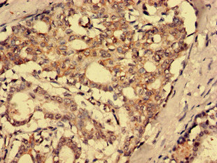 SFRP4 Antibody - Immunohistochemistry analysis of human breast cancer using SFRP4 Antibody at dilution of 1:100