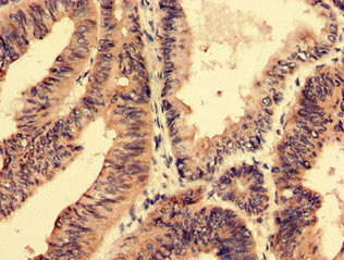 SFRP4 Antibody - Immunohistochemistry analysis of human colon cancer using SFRP4 Antibody at dilution of 1:100