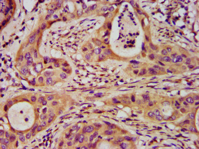 SFRP5 Antibody - Immunohistochemistry image at a dilution of 1:200 and staining in paraffin-embedded human cervical cancer performed on a Leica BondTM system. After dewaxing and hydration, antigen retrieval was mediated by high pressure in a citrate buffer (pH 6.0) . Section was blocked with 10% normal goat serum 30min at RT. Then primary antibody (1% BSA) was incubated at 4 °C overnight. The primary is detected by a biotinylated secondary antibody and visualized using an HRP conjugated SP system.