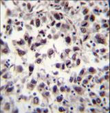 SFRS7 / 9G8 Antibody - SFRS7 Antibody immunohistochemistry of formalin-fixed and paraffin-embedded human hepatocarcinoma tissue followed by peroxidase-conjugated secondary antibody and DAB staining.