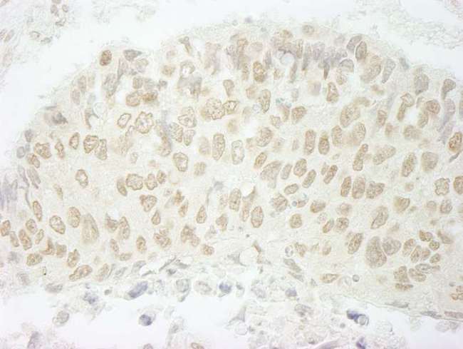 SFSWAP / SWAP Antibody - Detection of Human SFRS8/SWAP by Immunohistochemistry. Sample: FFPE section of human lung carcinoma. Antibody: Affinity purified rabbit anti-SFRS8/SWAP used at a dilution of 1:100. Epitope Retrieval Buffer-High pH (IHC-101J) was substituted for Epitope Retrieval Buffer-Reduced pH.