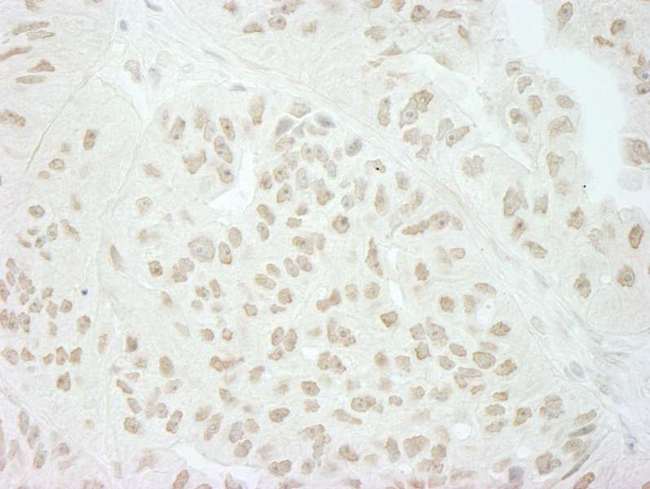 SFSWAP / SWAP Antibody - Detection of Human SFRS8/SWAP by Immunohistochemistry. Sample: FFPE section of human breast carcinoma. Antibody: Affinity purified rabbit anti-SFRS8/SWAP used at a dilution of 1:200 (1 ug/ml). Detection: DAB.