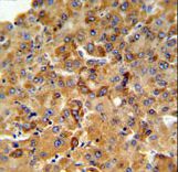 SFT2D3 Antibody - SFT2D3 Antibody IHC of formalin-fixed and paraffin-embedded human hepatocarcinoma followed by peroxidase-conjugated secondary antibody and DAB staining.