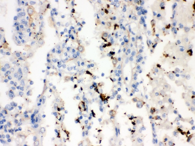 SFTPA1 + SFTPA2 Antibody - SFTP A1/2 antibody IHC-paraffin: Human Lung Cancer Tissue.