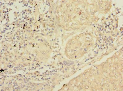 SFTPC / Surfactant Protein C Antibody - Immunohistochemistry of paraffin-embedded human lung cancer using antibody at dilution of 1:100.
