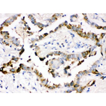 SFTPD / Surfactant Protein D Antibody - Surfactant protein D antibody IHC-paraffin. IHC(P): Human Lung Cancer Tissue.