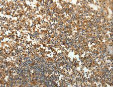 SFTPD / Surfactant Protein D Antibody - Immunohistochemistry of paraffin-embedded Human ovarian cancer using SFTPD Polyclonal Antibody at dilution of 1:30.