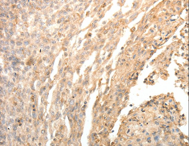 SFTPD / Surfactant Protein D Antibody - Immunohistochemistry of paraffin-embedded Human cervical cancer using SFTPD Polyclonal Antibody at dilution of 1:30.