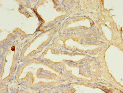 SFXN2 Antibody - Immunohistochemistry of paraffin-embedded human prostate cancer using antibody at dilution of 1:100.