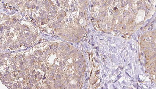 SGCG / Gamma-Sarcoglycan Antibody - 1:100 staining human thyroid carcinoma tissue by IHC-P. The sample was formaldehyde fixed and a heat mediated antigen retrieval step in citrate buffer was performed. The sample was then blocked and incubated with the antibody for 1.5 hours at 22°C. An HRP conjugated goat anti-rabbit antibody was used as the secondary.