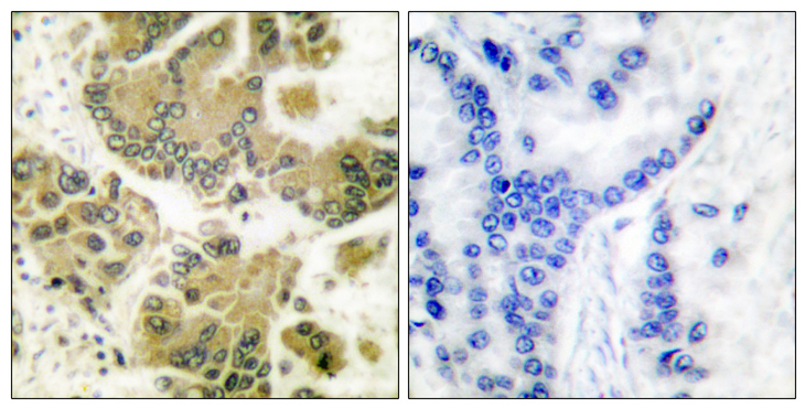 SGK1 / SGK Antibody - Immunohistochemistry analysis of paraffin-embedded human breast carcinoma tissue, using SGK Antibody. The picture on the right is blocked with the synthesized peptide.