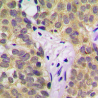 SGK1 / SGK Antibody - Immunohistochemical analysis of SGK1 (pS422) staining in human prostate cancer formalin fixed paraffin embedded tissue section. The section was pre-treated using heat mediated antigen retrieval with sodium citrate buffer (pH 6.0). The section was then incubated with the antibody at room temperature and detected using an HRP conjugated compact polymer system. DAB was used as the chromogen. The section was then counterstained with hematoxylin and mounted with DPX.