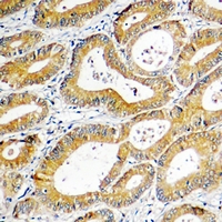 SGK1 / SGK Antibody - Immunohistochemical analysis of SGK1 staining in human colon cancer formalin fixed paraffin embedded tissue section. The section was pre-treated using heat mediated antigen retrieval with sodium citrate buffer (pH 6.0). The section was then incubated with the antibody at room temperature and detected using an HRP polymer system. DAB was used as the chromogen. The section was then counterstained with hematoxylin and mounted with DPX.