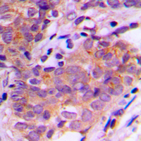 SGK1 / SGK Antibody - Immunohistochemical analysis of SGK1/2 staining in human breast cancer formalin fixed paraffin embedded tissue section. The section was pre-treated using heat mediated antigen retrieval with sodium citrate buffer (pH 6.0). The section was then incubated with the antibody at room temperature and detected using an HRP conjugated compact polymer system. DAB was used as the chromogen. The section was then counterstained with hematoxylin and mounted with DPX.