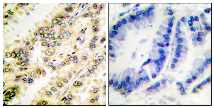 SGK1 / SGK Antibody - Immunohistochemistry analysis of paraffin-embedded human breast carcinoma, using SGK (Phospho-Ser422) Antibody. The picture on the right is blocked with the phospho peptide.