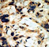 SGK2 Antibody - Formalin-fixed and paraffin-embedded human cancer tissue reacted with the primary antibody, which was peroxidase-conjugated to the secondary antibody, followed by DAB staining. This data demonstrates the use of this antibody for immunohistochemistry; clinical relevance has not been evaluated. BC = breast carcinoma; HC = hepatocarcinoma.