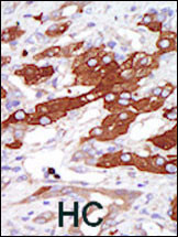 SGK3 Antibody - Formalin-fixed and paraffin-embedded human cancer tissue reacted with the primary antibody, which was peroxidase-conjugated to the secondary antibody, followed by DAB staining. This data demonstrates the use of this antibody for immunohistochemistry; clinical relevance has not been evaluated. BC = breast carcinoma; HC = hepatocarcinoma.