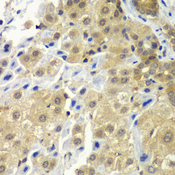 SGTA / SGT Antibody - Immunohistochemistry of paraffin-embedded human liver cancer tissue.
