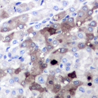 SGTA / SGT Antibody - Immunohistochemical analysis of SGTA staining in human liver cancer formalin fixed paraffin embedded tissue section. The section was pre-treated using heat mediated antigen retrieval with sodium citrate buffer (pH 6.0). The section was then incubated with the antibody at room temperature and detected using an HRP conjugated compact polymer system. DAB was used as the chromogen. The section was then counterstained with hematoxylin and mounted with DPX.