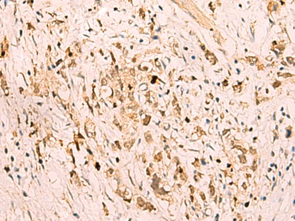 SGTA / SGT Antibody - Immunohistochemistry of paraffin-embedded Human gastric cancer tissue  using SGTA Polyclonal Antibody at dilution of 1:75(×200)