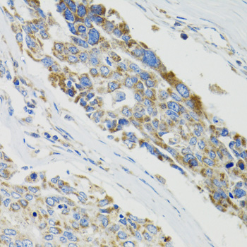 SH2B1 Antibody - Immunohistochemistry of paraffin-embedded human liver cancer tissue.