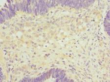 SH2B1 Antibody - Immunohistochemistry of paraffin-embedded human ovarian cancer tissue at dilution 1:100