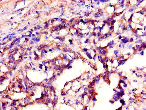 SH2D1A / SAP Antibody - Immunohistochemistry of paraffin-embedded human gastric cancer using SH2D1A Antibody at dilution of 1:100
