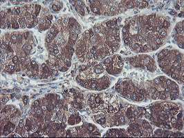 SH2D2A Antibody - IHC of paraffin-embedded Carcinoma of Human liver tissue using anti-SH2D2A mouse monoclonal antibody.