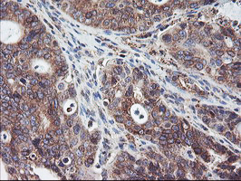 SH2D2A Antibody - IHC of paraffin-embedded Carcinoma of Human pancreas tissue using anti-SH2D2A mouse monoclonal antibody.