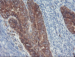 SH2D2A Antibody - IHC of paraffin-embedded Adenocarcinoma of Human endometrium tissue using anti-SH2D2A mouse monoclonal antibody.
