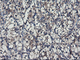 SH2D2A Antibody - IHC of paraffin-embedded Carcinoma of Human kidney tissue using anti-SH2D2A mouse monoclonal antibody.