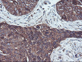 SH2D2A Antibody - IHC of paraffin-embedded Carcinoma of Human lung tissue using anti-SH2D2A mouse monoclonal antibody.