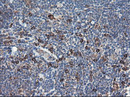 SH2D2A Antibody - IHC of paraffin-embedded Human lymphoma tissue using anti-SH2D2A mouse monoclonal antibody.