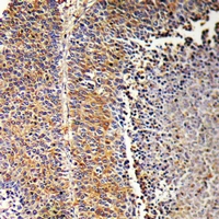 SH2D2A Antibody - Immunohistochemical analysis of SH2D2A staining in human liver cancer formalin fixed paraffin embedded tissue section. The section was pre-treated using heat mediated antigen retrieval with sodium citrate buffer (pH 6.0). The section was then incubated with the antibody at room temperature and detected with HRP and DAB as chromogen. The section was then counterstained with hematoxylin and mounted with DPX.