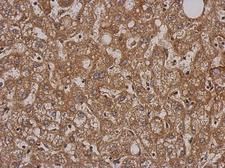 SH2D3C / NSP3 Antibody - IHC of paraffin-embedded Hepatoma, using SH2D3C antibody at 1:500 dilution.