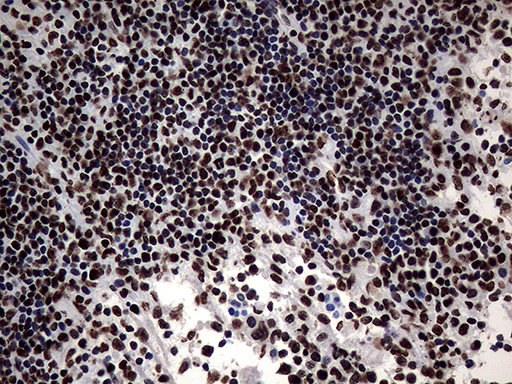 SH3BGRL Antibody - Immunohistochemical staining of paraffin-embedded Carcinoma of Human lung tissue using anti-SH3BGRL mouse monoclonal antibody. (Heat-induced epitope retrieval by 1mM EDTA in 10mM Tris buffer. (pH8.5) at 120°C for 3 min. (1:150)