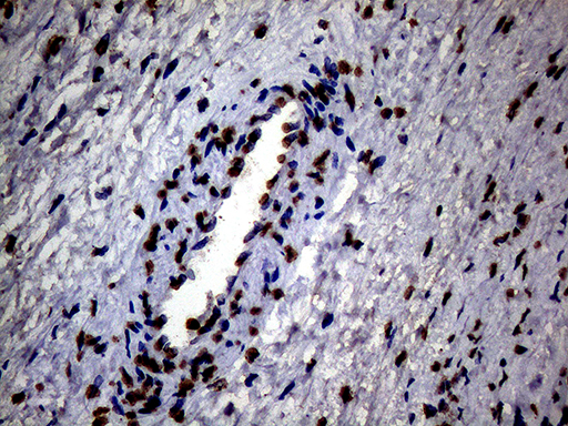 SH3BGRL Antibody - Immunohistochemical staining of paraffin-embedded Adenocarcinoma of Human ovary tissue using anti-SH3BGRL mouse monoclonal antibody. (Heat-induced epitope retrieval by 1mM EDTA in 10mM Tris buffer. (pH8.5) at 120°C for 3 min. (1:150)