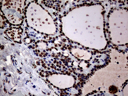 SH3BGRL Antibody - Immunohistochemical staining of paraffin-embedded Human thyroid tissue within the normal limits using anti-SH3BGRL mouse monoclonal antibody. (Heat-induced epitope retrieval by 1mM EDTA in 10mM Tris buffer. (pH8.5) at 120°C for 3 min. (1:150)