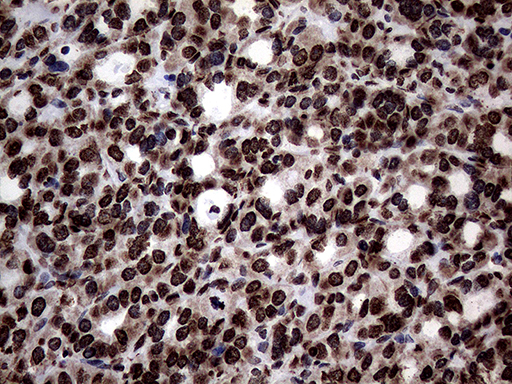 SH3BGRL Antibody - Immunohistochemical staining of paraffin-embedded Carcinoma of Human thyroid tissue using anti-SH3BGRL mouse monoclonal antibody. (Heat-induced epitope retrieval by 1mM EDTA in 10mM Tris buffer. (pH8.5) at 120°C for 3 min. (1:150)