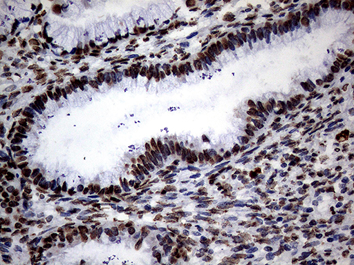 SH3BGRL Antibody - Immunohistochemical staining of paraffin-embedded Adenocarcinoma of Human endometrium tissue using anti-SH3BGRL mouse monoclonal antibody. (Heat-induced epitope retrieval by 1mM EDTA in 10mM Tris buffer. (pH8.5) at 120°C for 3 min. (1:150)