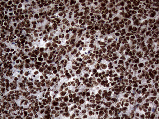 SH3BGRL Antibody - Immunohistochemical staining of paraffin-embedded Human lymph node tissue within the normal limits using anti-SH3BGRL mouse monoclonal antibody. (Heat-induced epitope retrieval by 1mM EDTA in 10mM Tris buffer. (pH8.5) at 120°C for 3 min. (1:150)